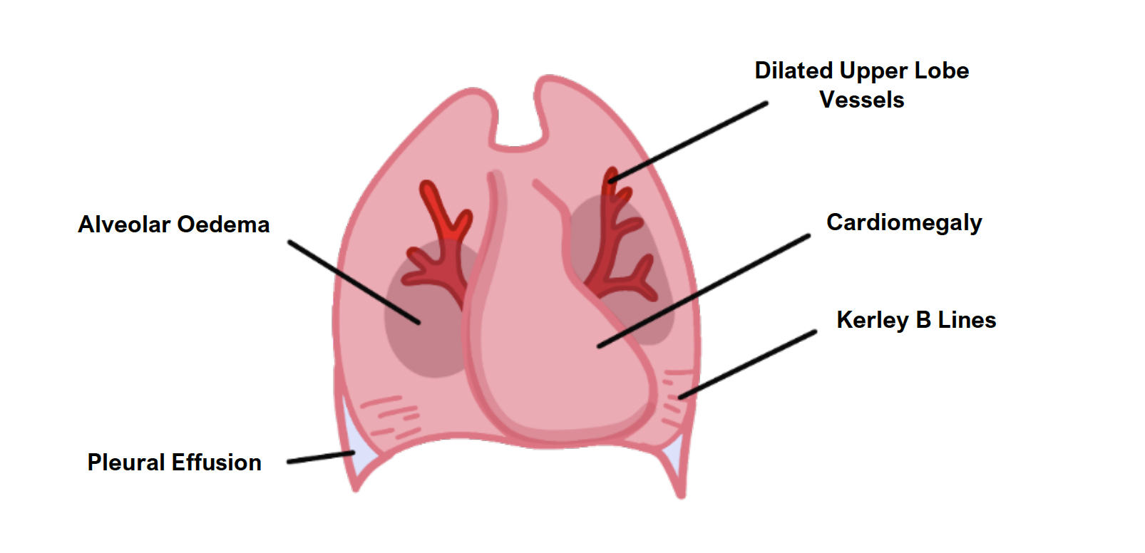 Screenshot 2023-06-15 at 14.59.56 right ventricular failure