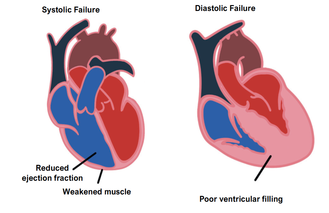 Systolic and diastolic failure