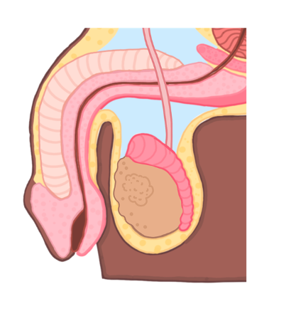 Testicular cancer