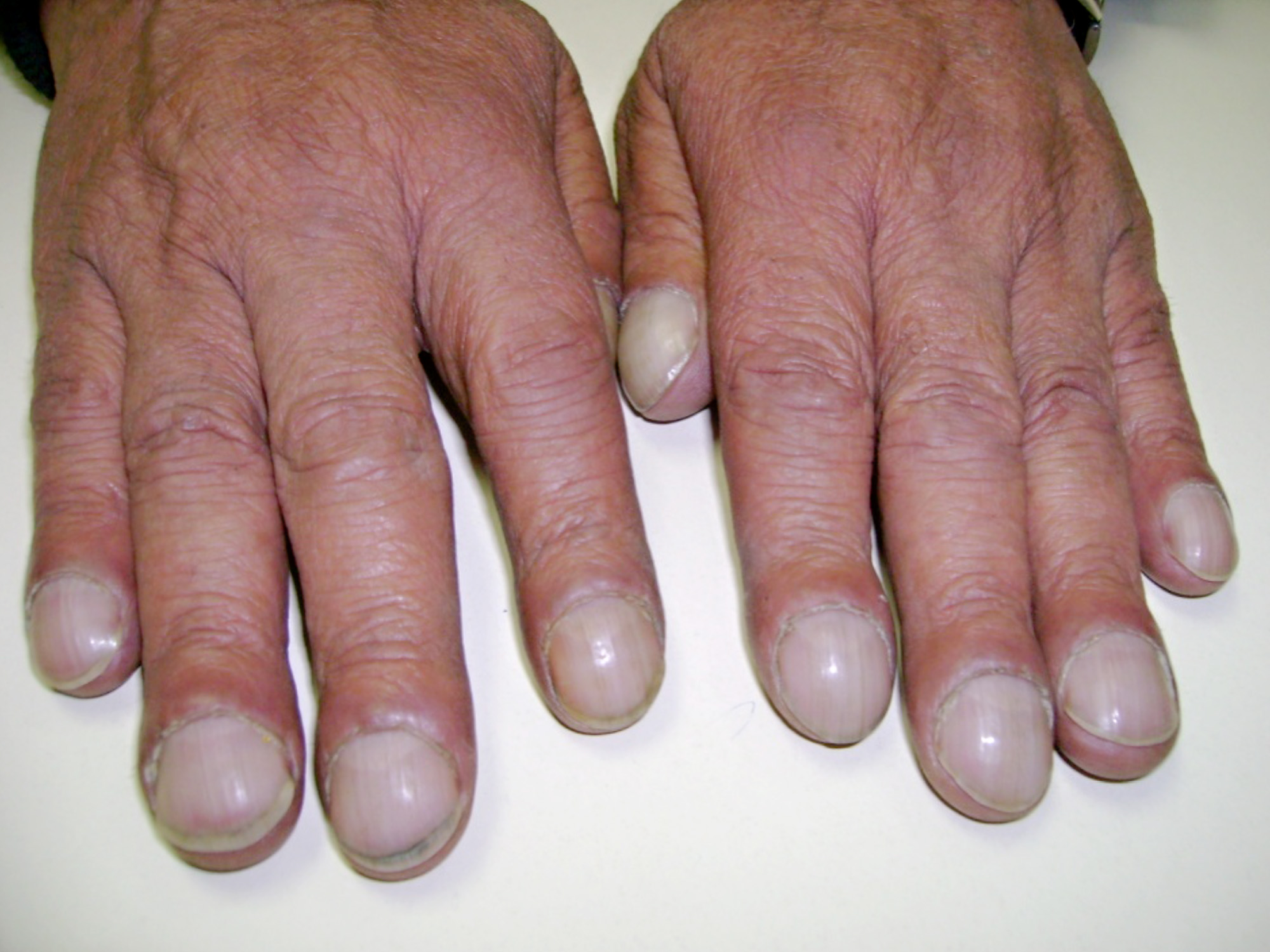 Finger clubbing