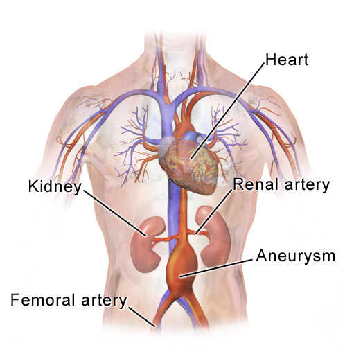 Abdominal_Aortic_Aneurysm_Location