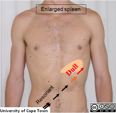 Enlarged Spleen