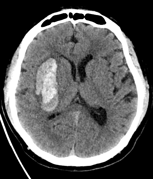 headache and vomiting head CT headache and vomiting head CT