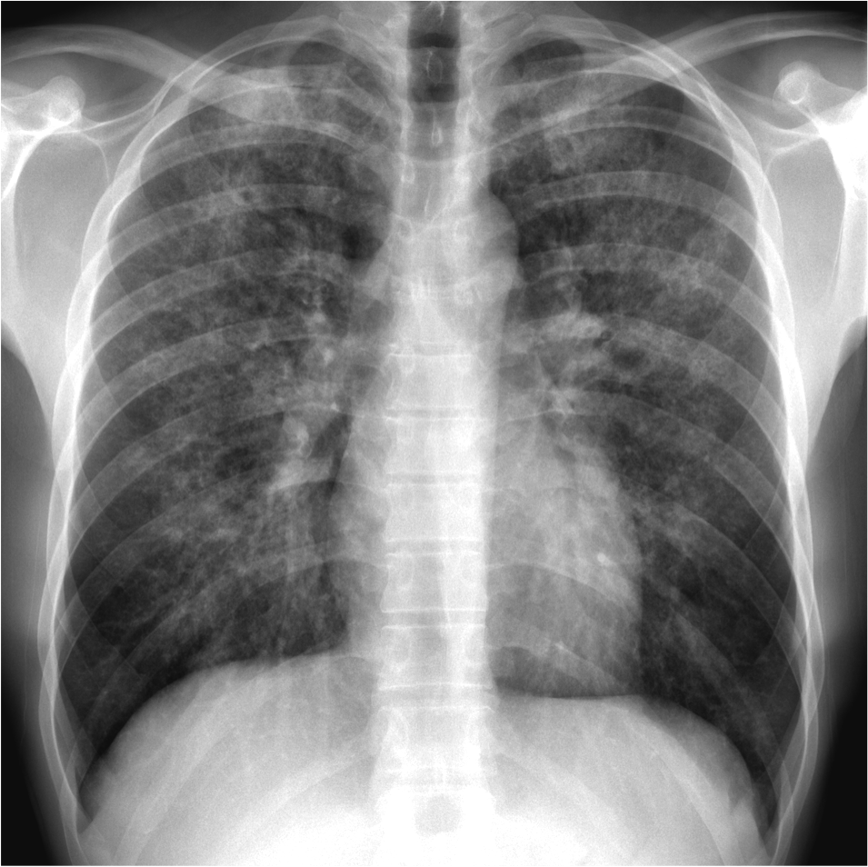 chest x-ray dry cough chest x-ray dry cough