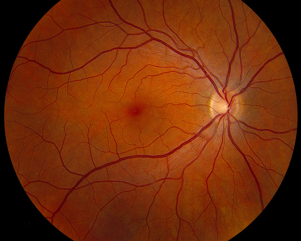 Fundoscopy Fundoscopy