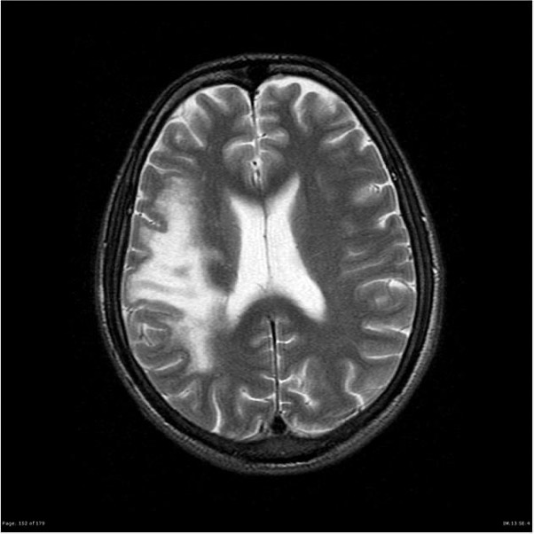 brain MRI brain MRI