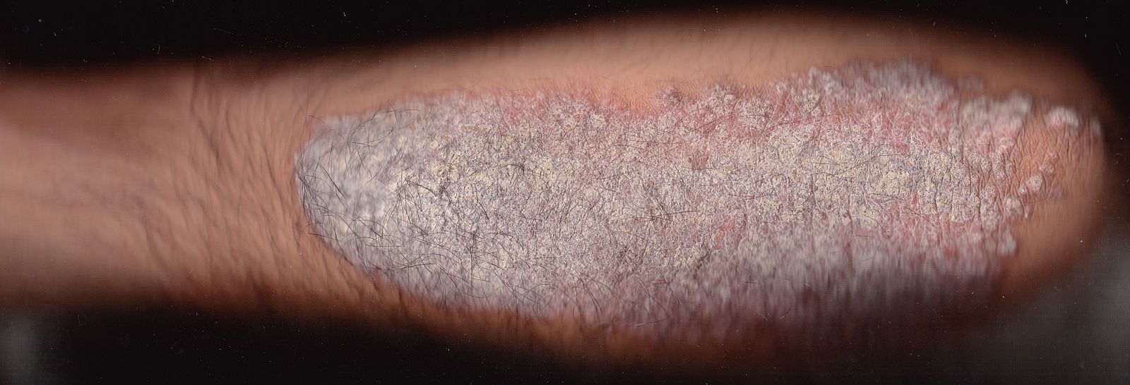 Plaque Psoriasis