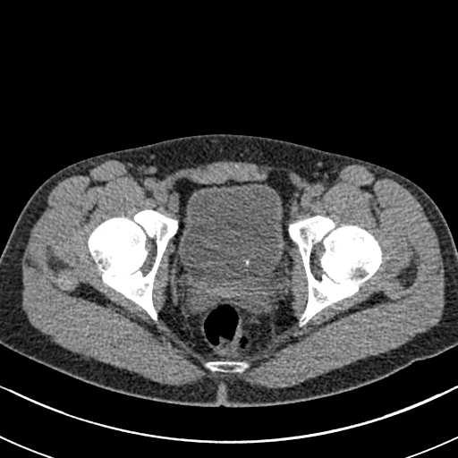non-contrast CT-KUB non-contrast CT-KUB