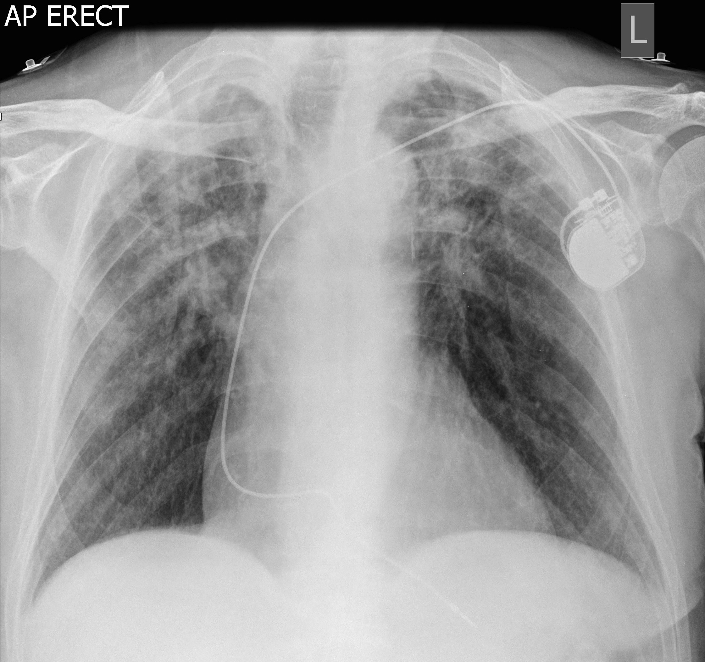 shortness of breath X-ray shortness of breath X-ray