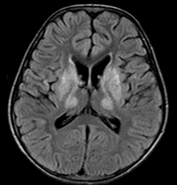 child brain MRI child brain MRI
