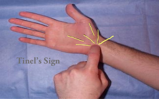 Tinels' Test
