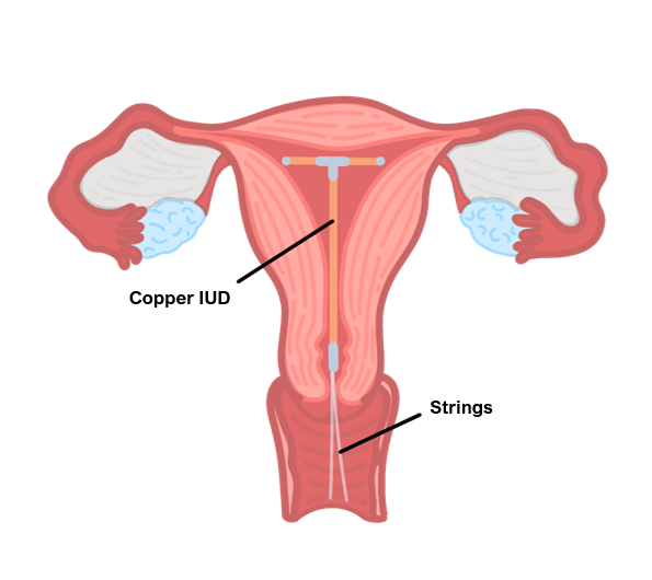 iUD