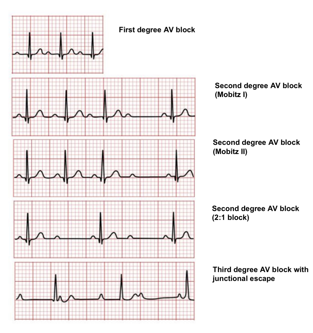 IMG-0686 AV heartblock