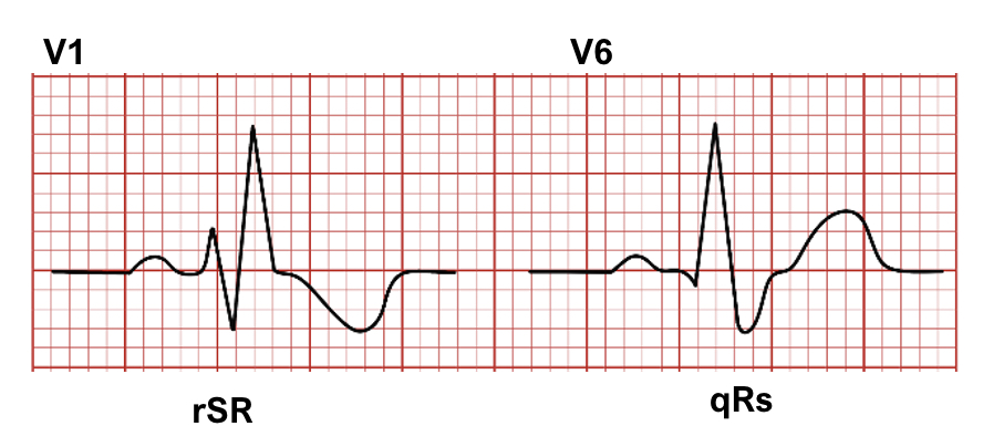 IMG-0695 right bundle branch block