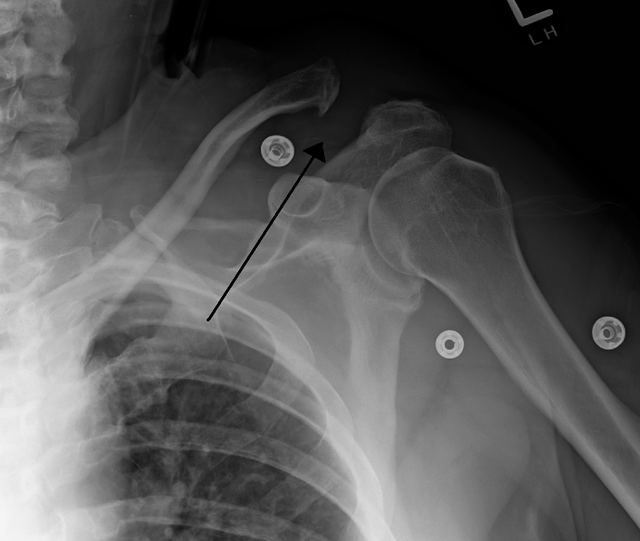 AC dislocation