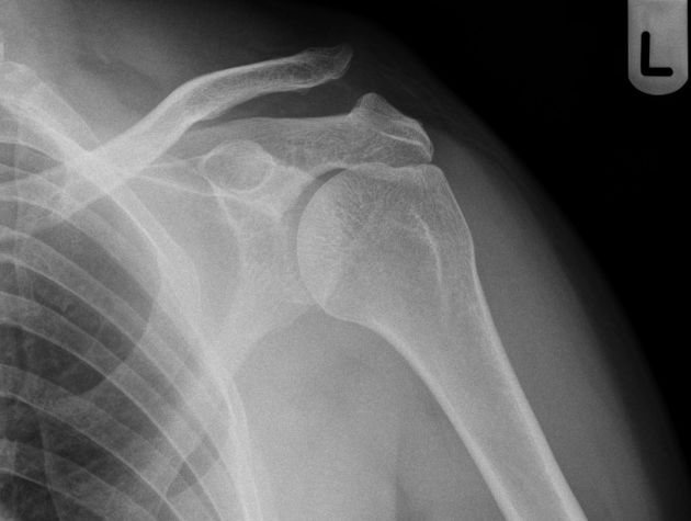 AC joint dislocation