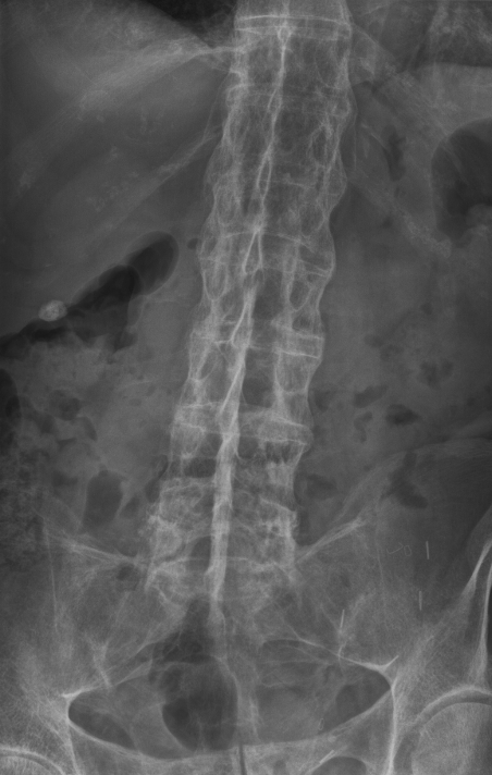 Ankolysing spondylosis