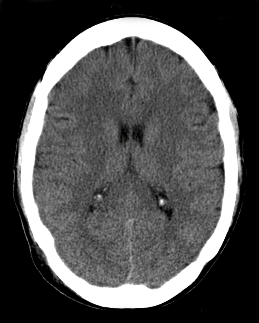 Brain_CT_scan normal