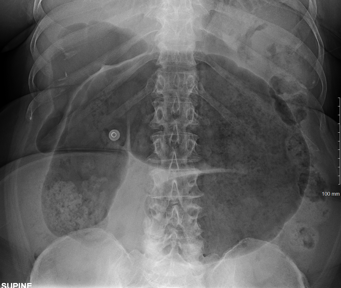 CecalVolvulus