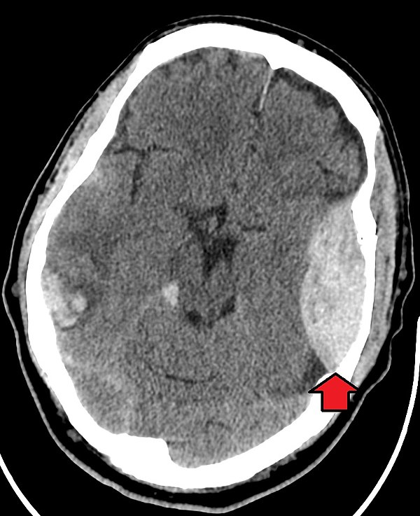 EpiduralHematoma