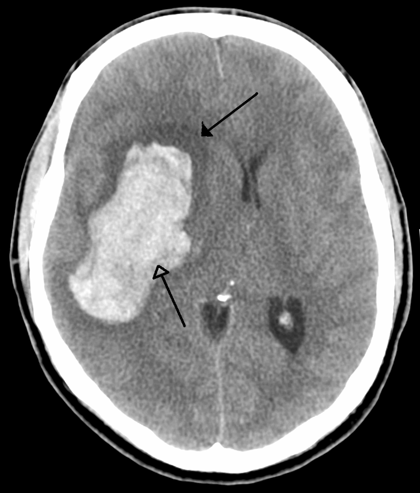 Intracerebral haemorrhage