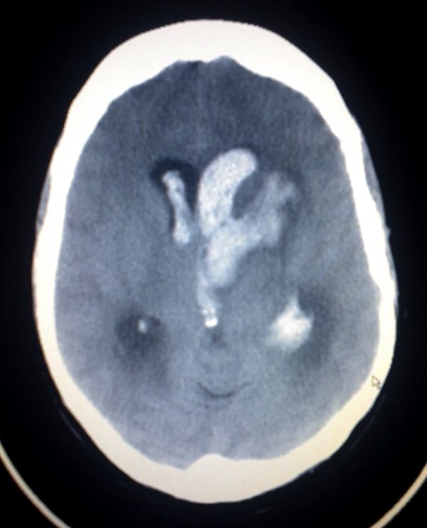 Intracerebral_hemorrage