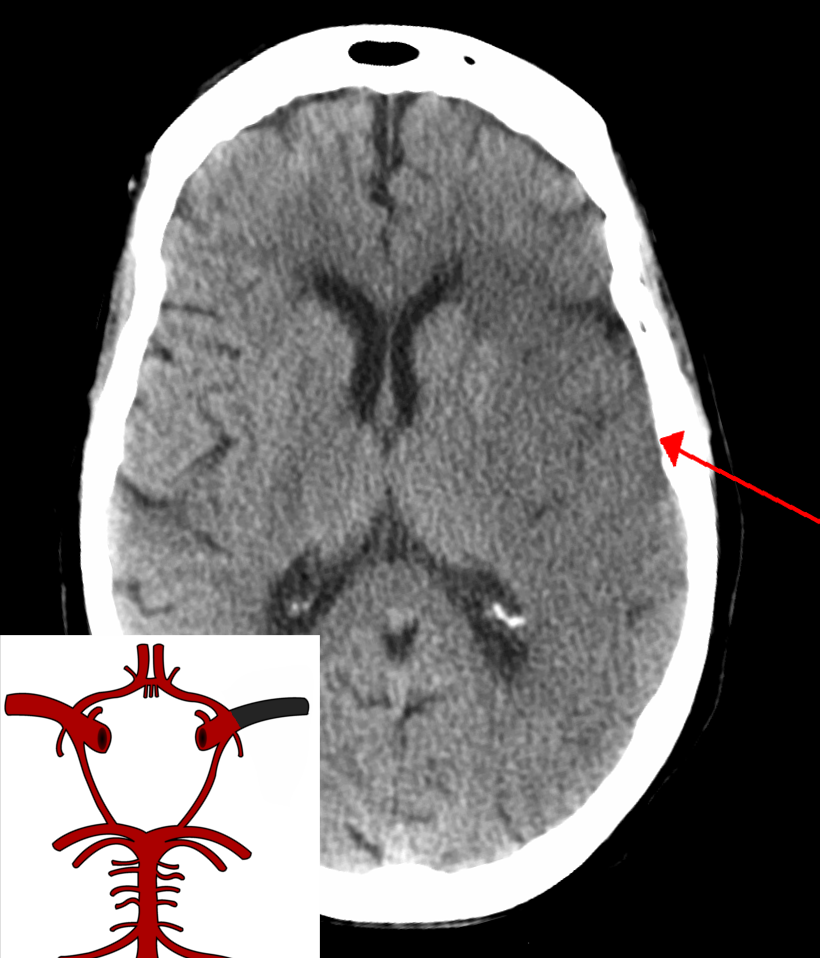 MCA Stroke