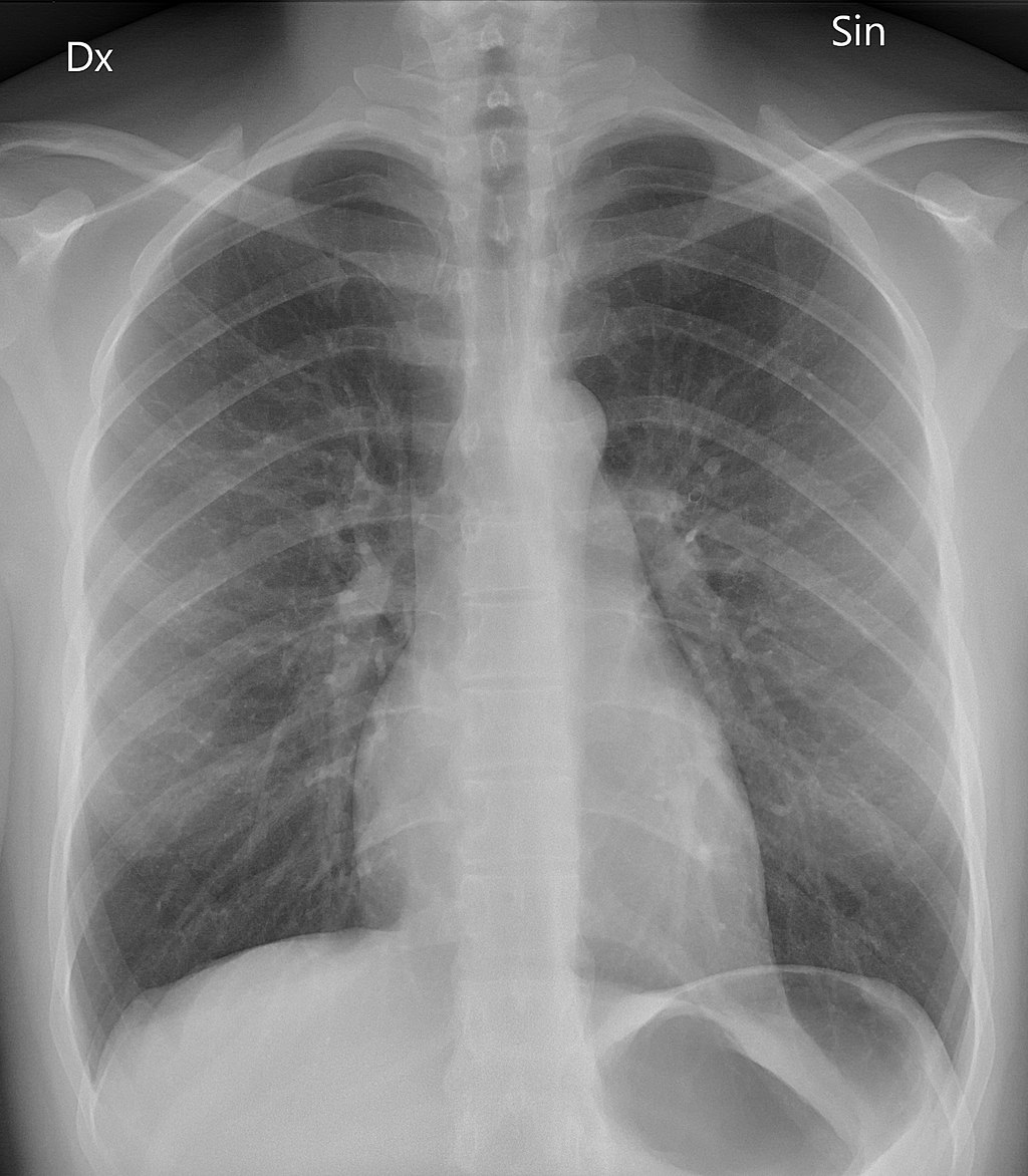 Normal CXR
