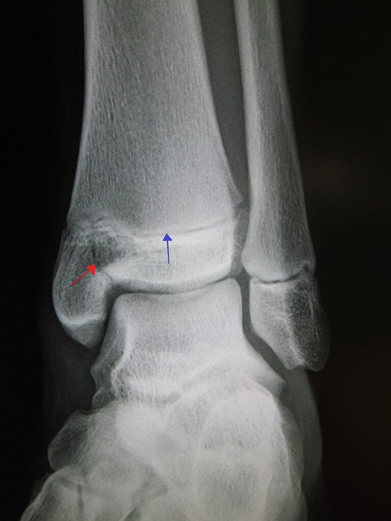 Salter-Harris fracture