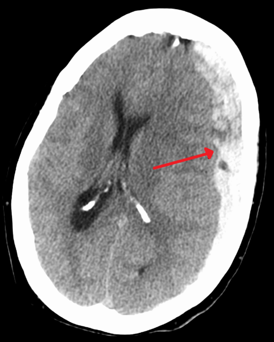 Subduralandherniation