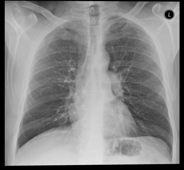 broncho carcinoma primary cancer