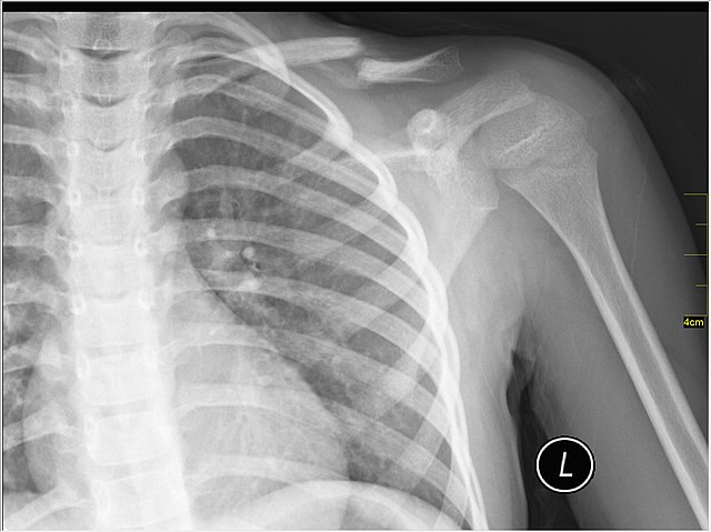 clavicle fracture