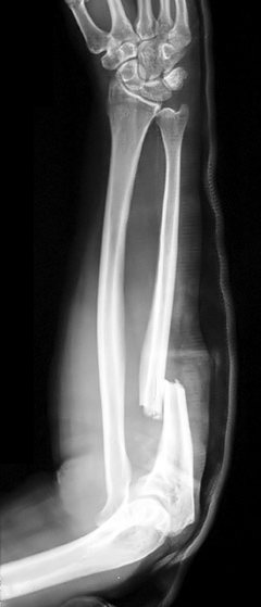 distal ulnar fracture