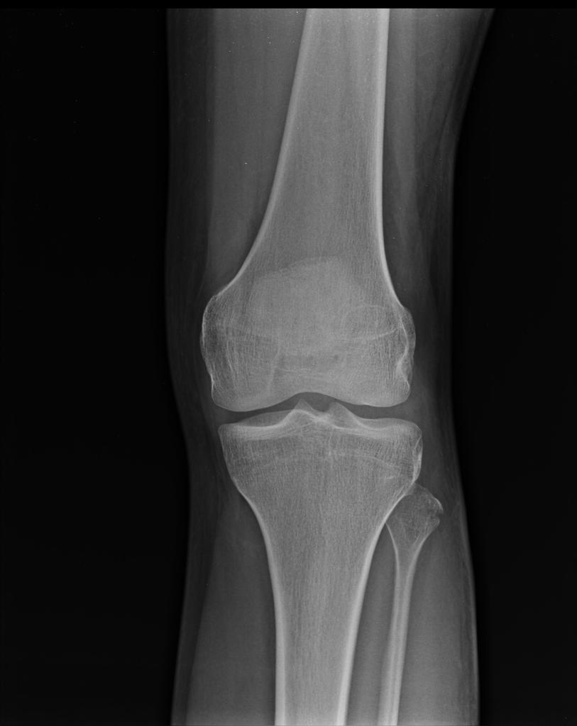 fibular head
