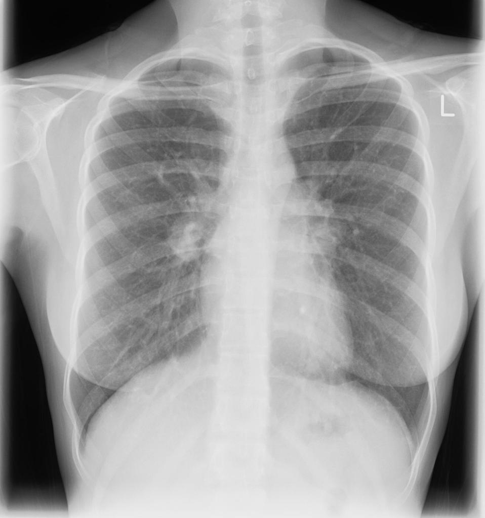 hilar lymphadenopathy