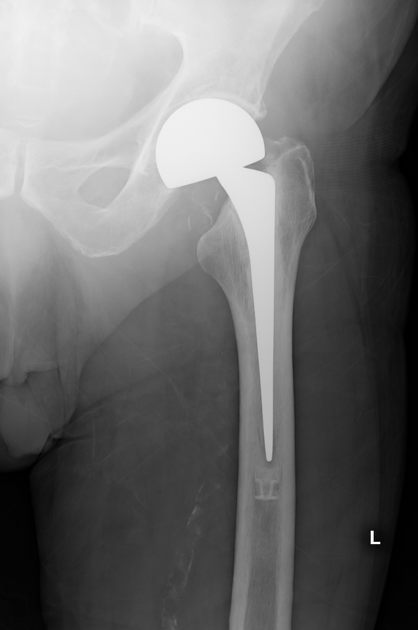 hip hemiarthroplasty