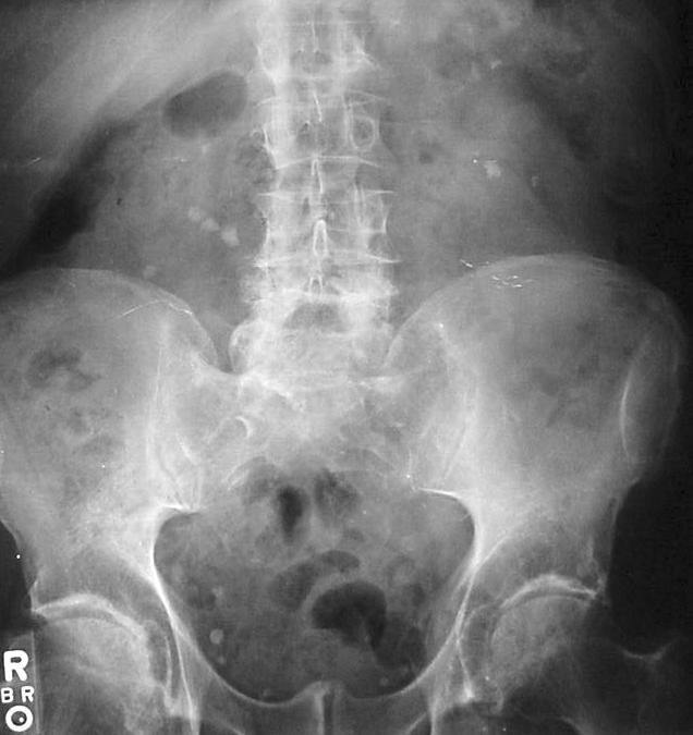 kidney stones