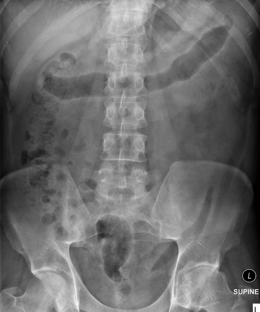 lead pipe colon
