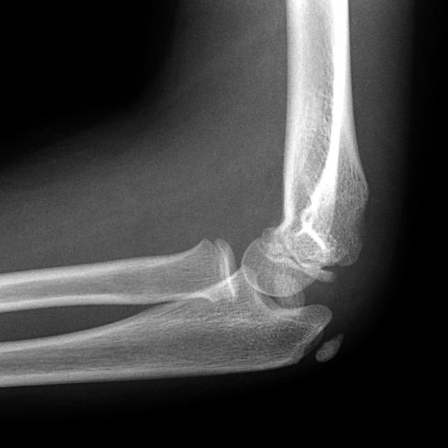 medial conduyle