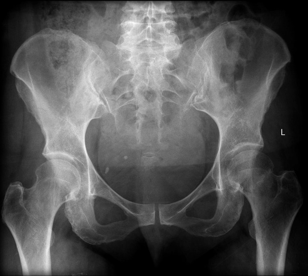 nof fracture