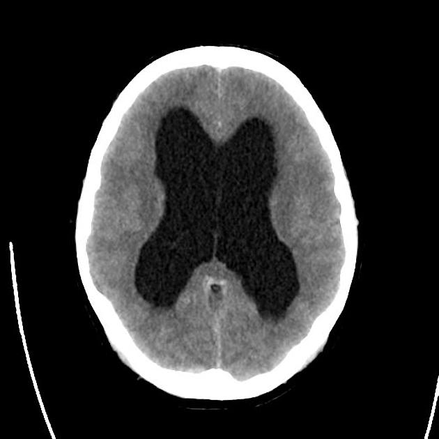 obstructive hydrocephalis