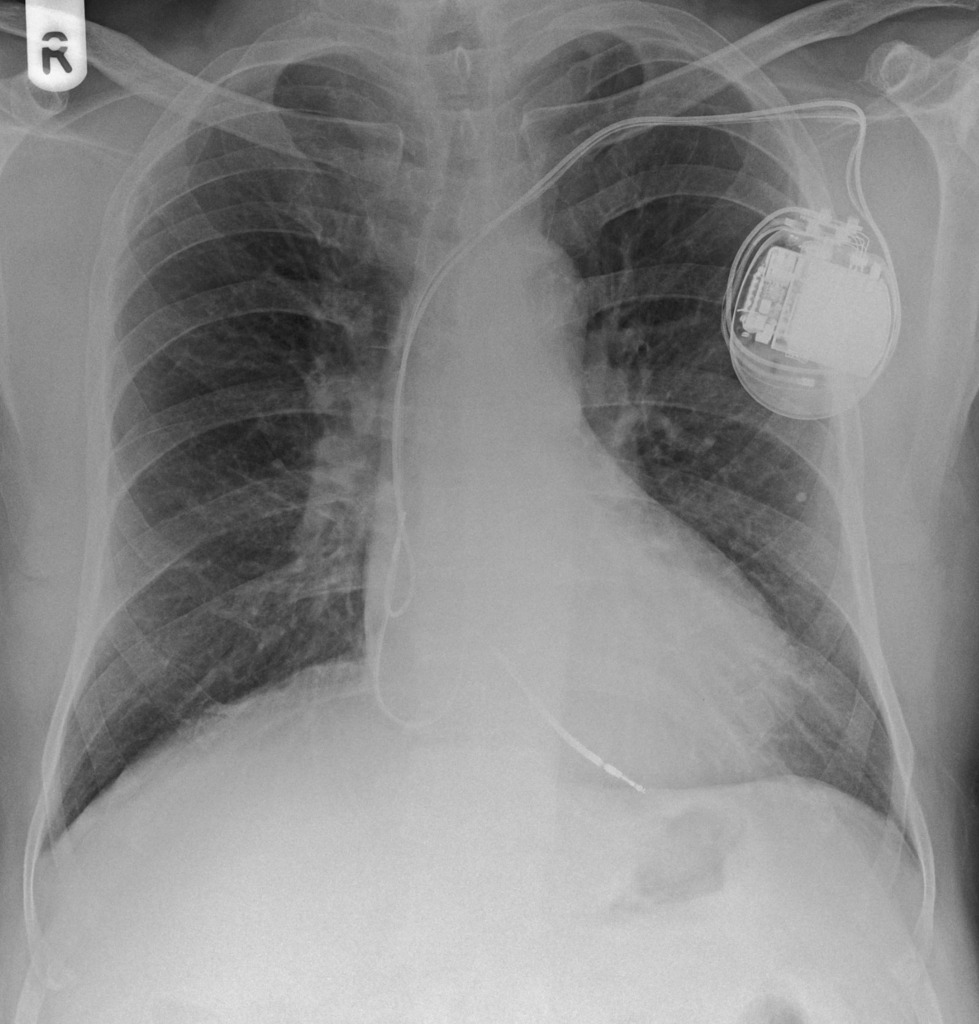 pacemaker
