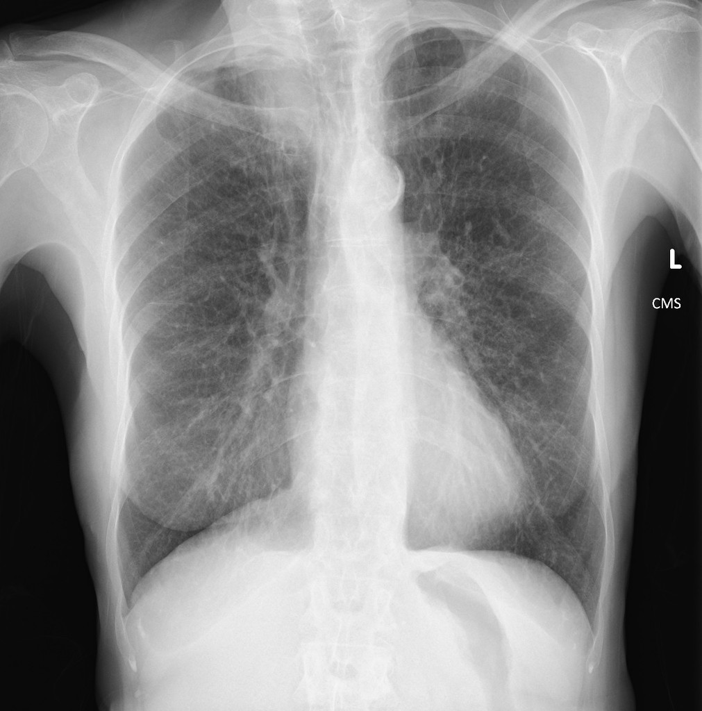 pancoast tumour