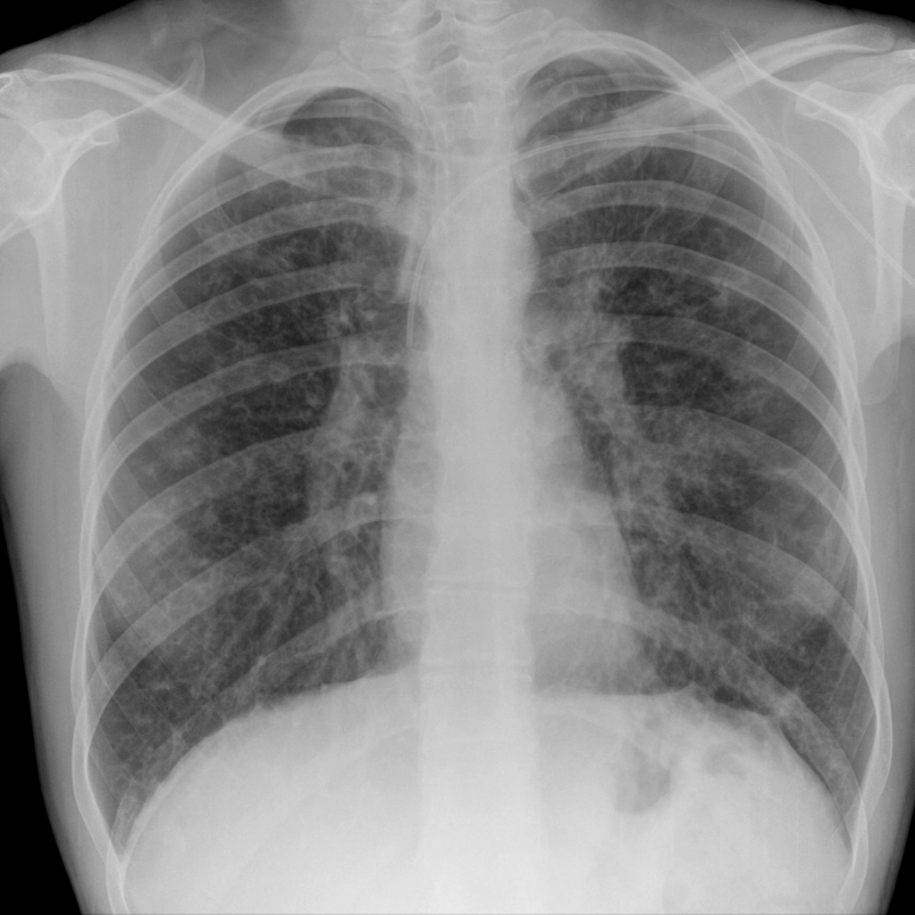 picc line