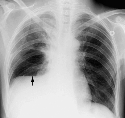 pleural effusion