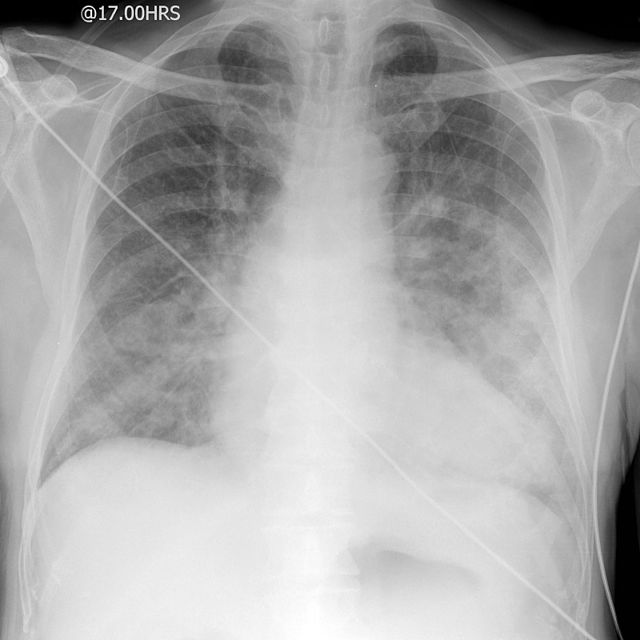 pulmonary edema