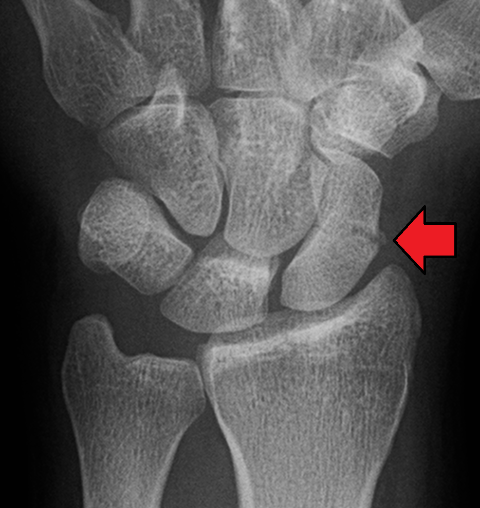 scaphoid fracture