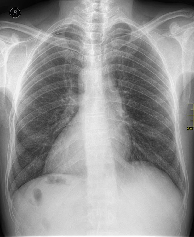 situs invertus