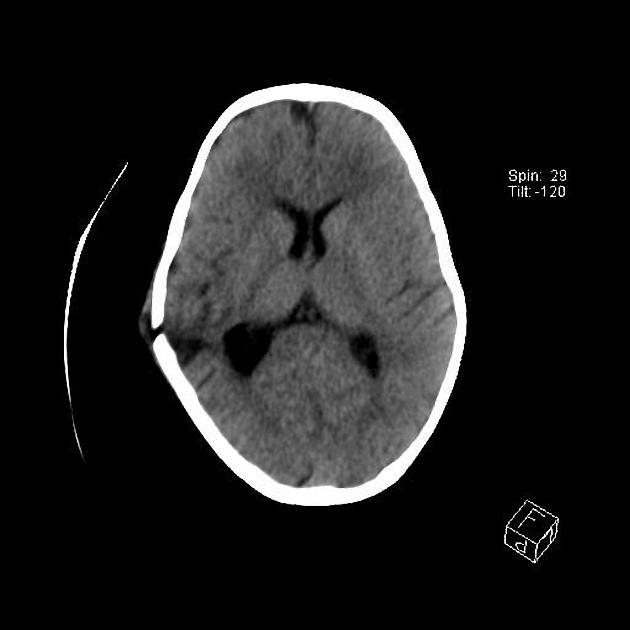 skull fracture