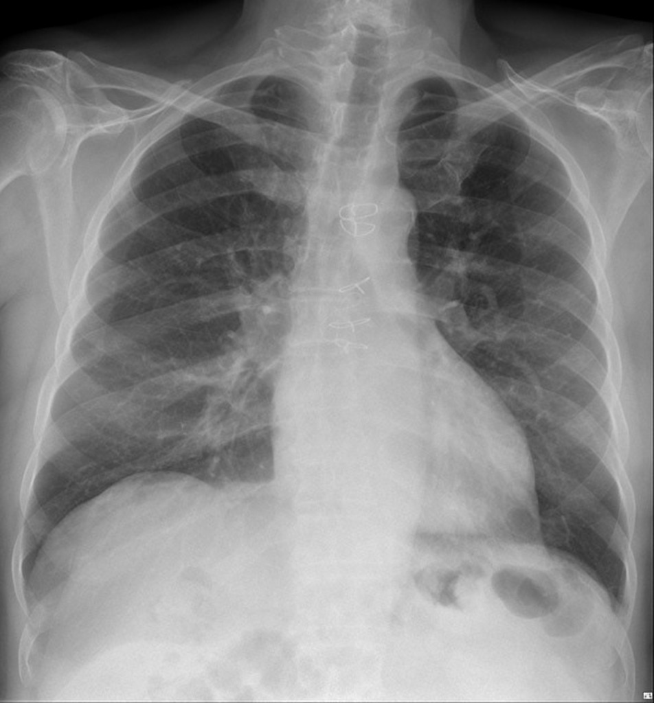 sternotomy wires